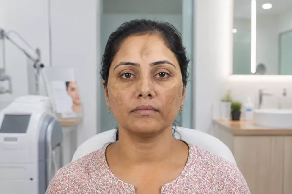 CHEMICAL PEEL (Before)