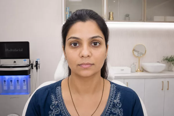 Hydrafacial (After)