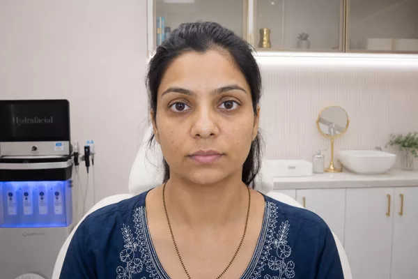 Hydrafacial (Before)