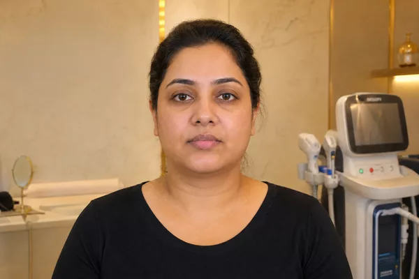Lipolysis (After)